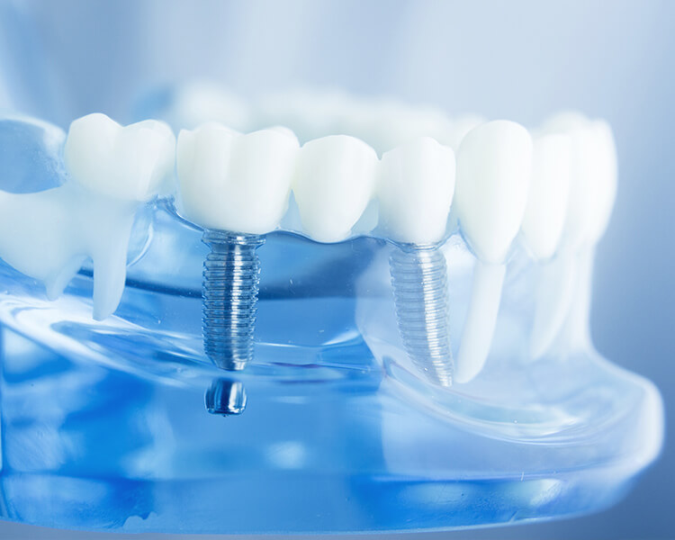 Implant image